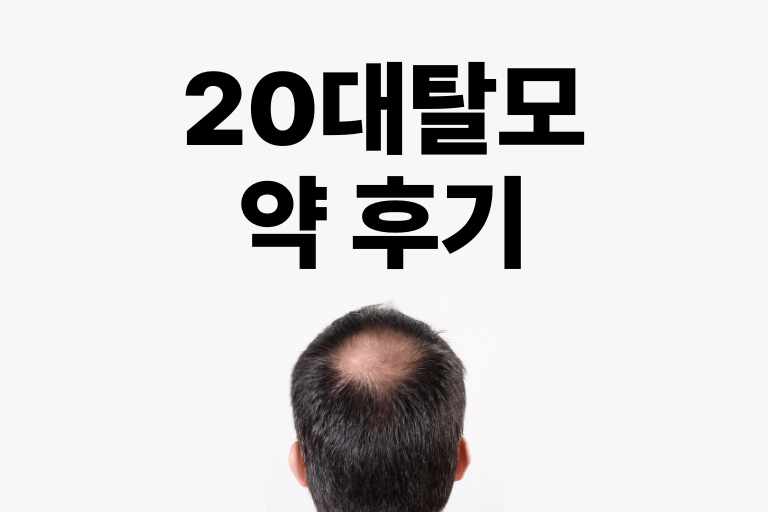 20대 탈모 약 후기